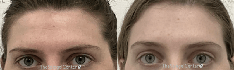 Browlift / Fox Eye Lift Before & After Gallery - Patient 240966 - Image 1