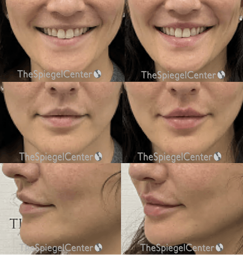 Lip Filler Before & After Gallery - Patient 221214 - Image 1