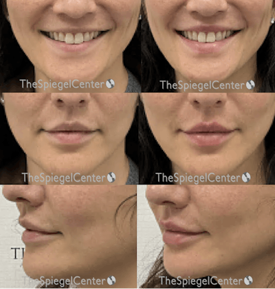 Lip Filler Before & After Gallery - Patient 221214 - Image 1