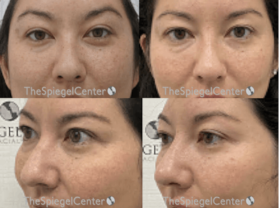 Non-Surgical Rhinoplasty / Nose Filler Before & After Gallery - Patient 304248 - Image 1