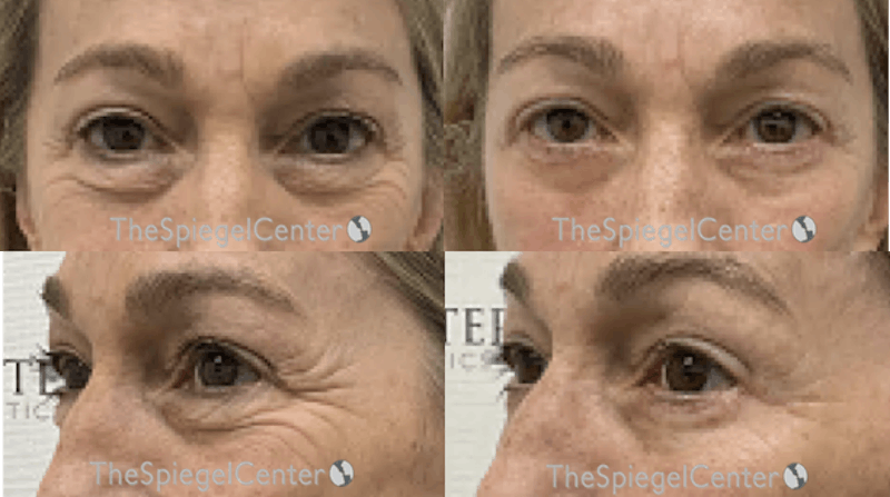 Blepharoplasty Before & After Gallery - Patient 183062 - Image 1