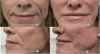 Lip Lift Before & After Gallery - Patient 163958 - Image 1