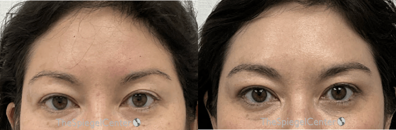 Temple Filler Before & After Gallery - Patient 220072 - Image 1