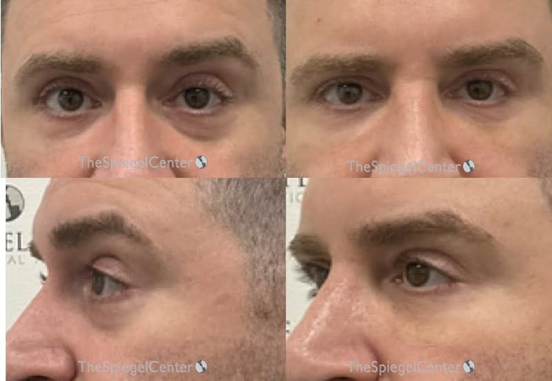 Tear Trough / Under Eye Fillers Before & After Gallery - Patient 201847 - Image 1