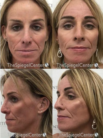 Facial Fat Grafting Before & After Gallery - Patient 170623 - Image 1