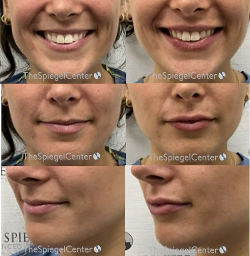 Lip Filler Before & After Gallery - Patient 360399 - Image 1