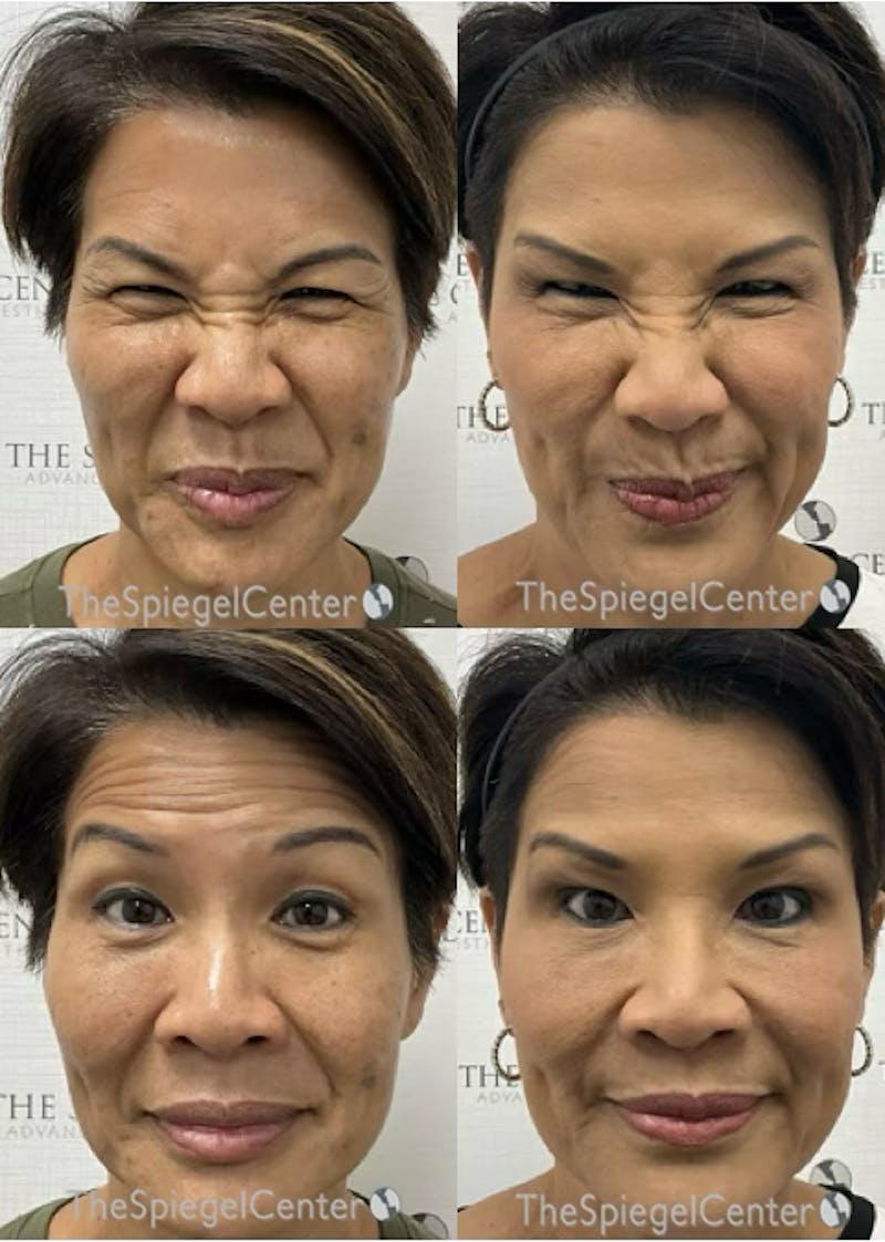 Botox / Dysport / Jeuveau / Xeomin Before & After Gallery - Patient 404190 - Image 1