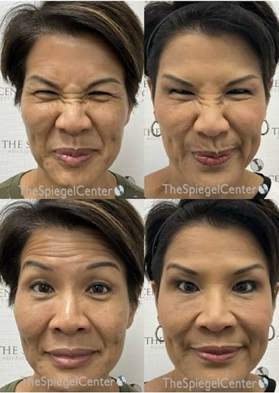 Botox / Dysport / Jeuveau / Xeomin Before & After Gallery - Patient 404190 - Image 1