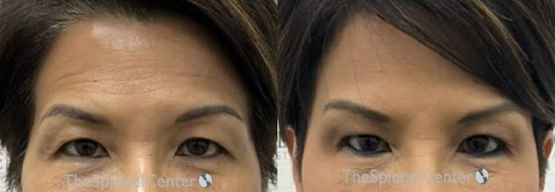 Temple Filler Before & After Gallery - Patient 345548 - Image 1