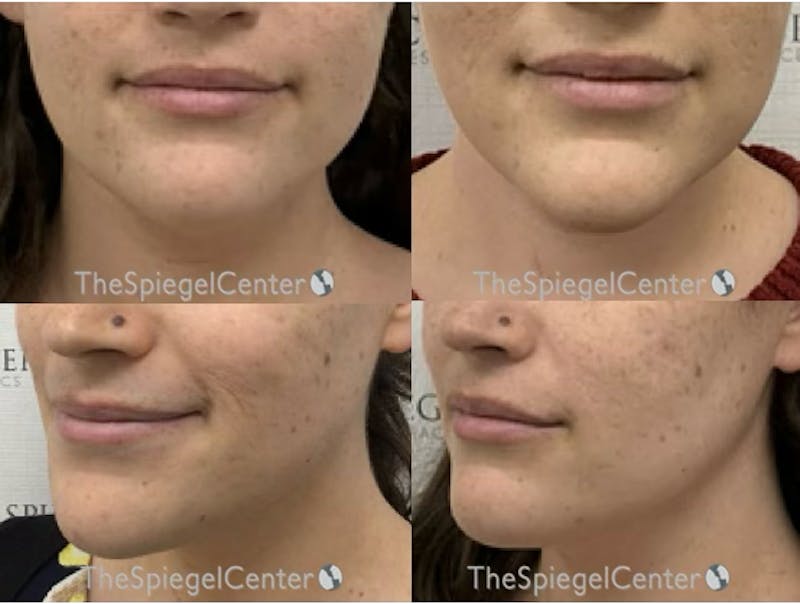 Mandible Contouring Before & After Gallery - Patient 355393 - Image 1