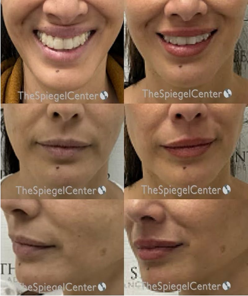 Lip Filler Before & After Gallery - Patient 507695 - Image 1