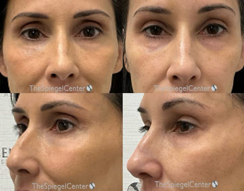 Non-Surgical Rhinoplasty / Nose Filler Before & After Gallery - Patient 295456 - Image 1