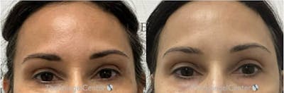 Temple Filler Before & After Gallery - Patient 138373 - Image 1
