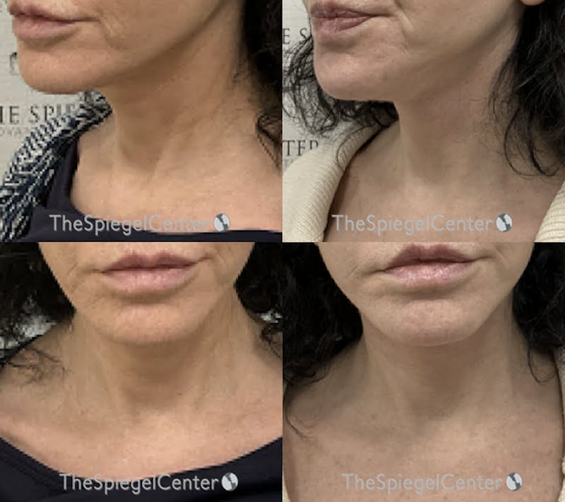 Neck Lift Before & After Gallery - Patient 230063 - Image 1
