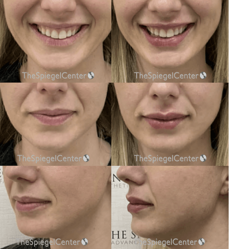 Lip Filler Before & After Gallery - Patient 641799 - Image 1
