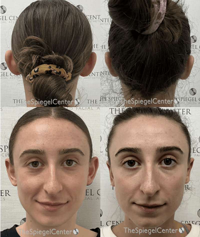 Ear Pinning / Otoplasty Before & After Gallery - Patient 306146 - Image 1