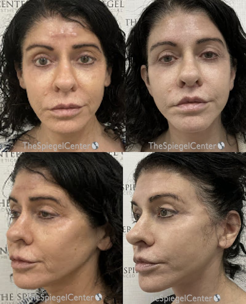 Facelift Before & After Gallery - Patient 356414 - Image 1