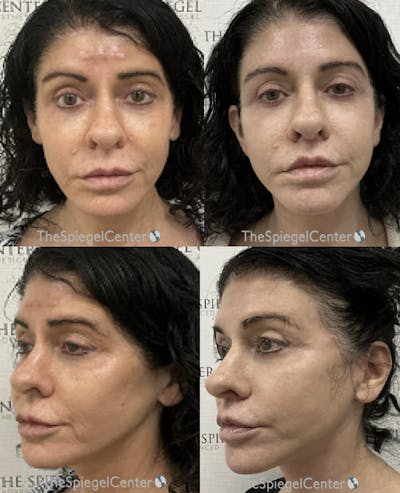 Facelift Before & After Gallery - Patient 356414 - Image 1