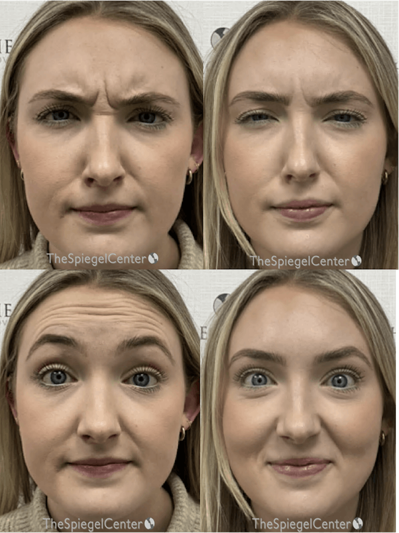Botox / Dysport / Jeuveau / Xeomin Before & After Gallery - Patient 107666 - Image 1