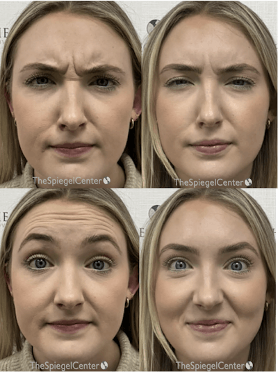 Botox / Dysport / Jeuveau / Xeomin Before & After Gallery - Patient 107666 - Image 1