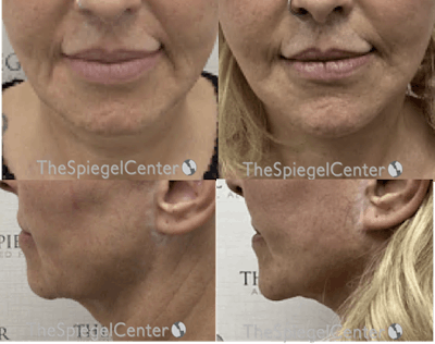 Chin Augmentation Before & After Gallery - Patient 238596 - Image 1