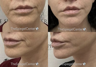 Ellacor Before & After Gallery - Patient 251638 - Image 1