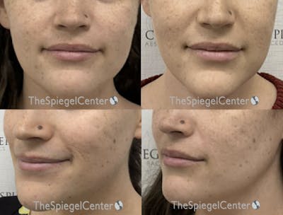 Facial Fat Grafting Before & After Gallery - Patient 261596 - Image 1