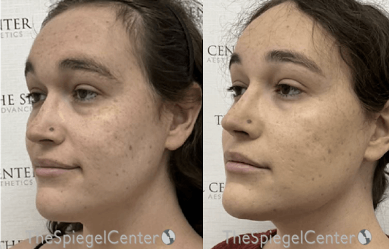 Morpheus8 Before & After Gallery - Patient 182488 - Image 1