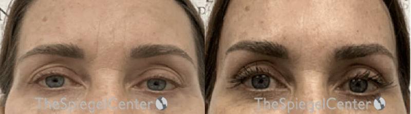 Browlift / Fox Eye Lift Before & After Gallery - Patient 415379 - Image 1