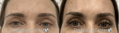 Browlift / Fox Eye Lift Before & After Gallery - Patient 415379 - Image 1