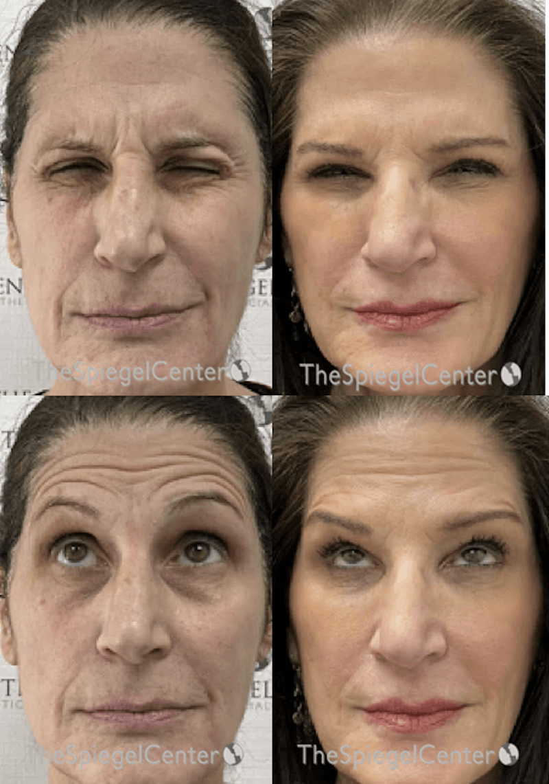 Botox / Dysport / Jeuveau / Xeomin Before & After Gallery - Patient 258380 - Image 1