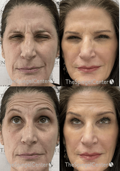 Botox / Dysport / Jeuveau / Xeomin Before & After Gallery - Patient 258380 - Image 1