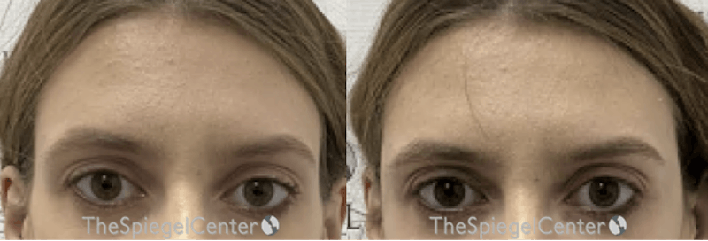 Temple Filler Before & After Gallery - Patient 229677 - Image 1