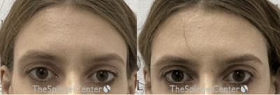 Temple Filler Before & After Gallery - Patient 229677 - Image 1