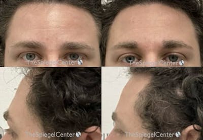 Forehead Contouring Before & After Gallery - Patient 115571 - Image 1