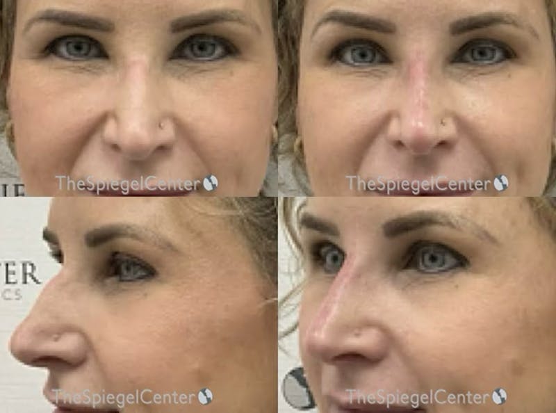 Non-Surgical Rhinoplasty / Nose Filler Before & After Gallery - Patient 237841 - Image 1