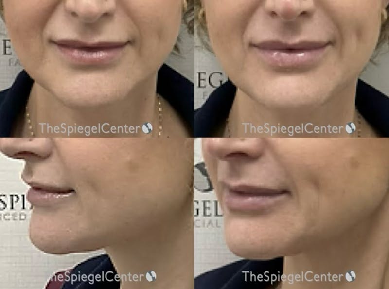Chin Filler Before & After Gallery - Patient 348562 - Image 1