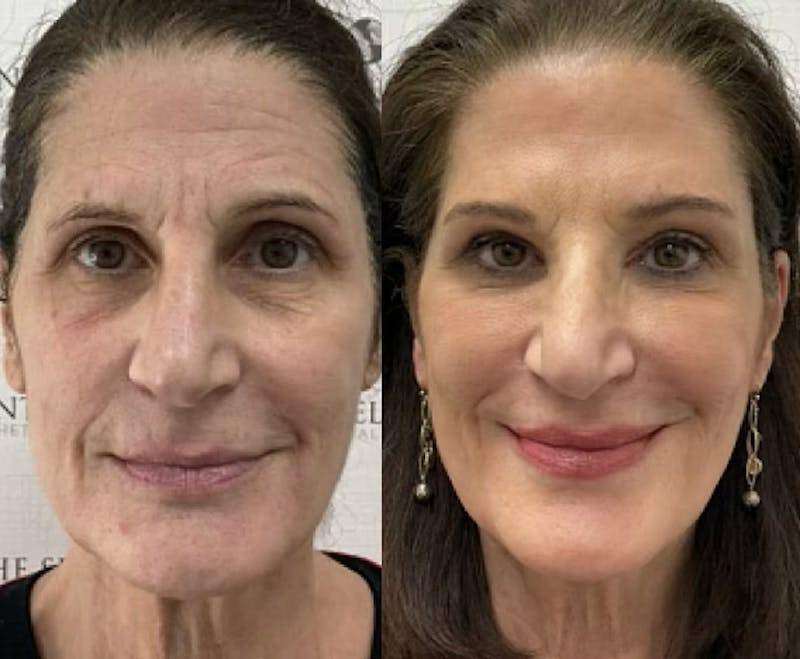 Liquid Face Lift Before & After Gallery - Patient 347121 - Image 1