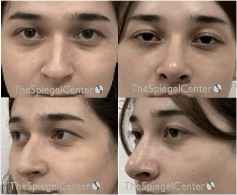 Rhinoplasty Before & After Gallery - Patient 519011 - Image 1