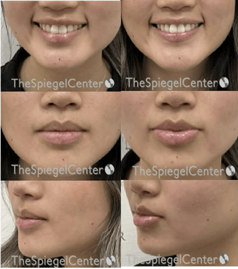 Lip Filler Before & After Gallery - Patient 372837 - Image 1