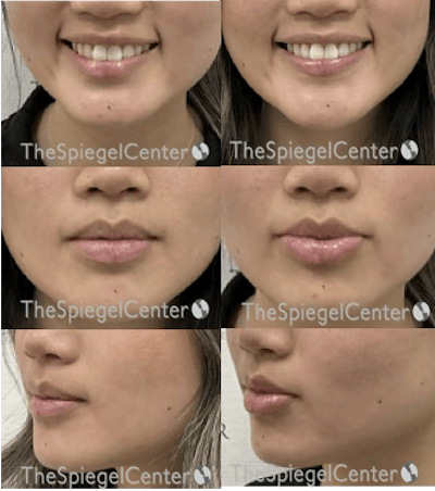 Lip Filler Before & After Gallery - Patient 372837 - Image 1