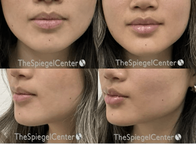 Chin Filler Before & After Gallery - Patient 352741 - Image 1