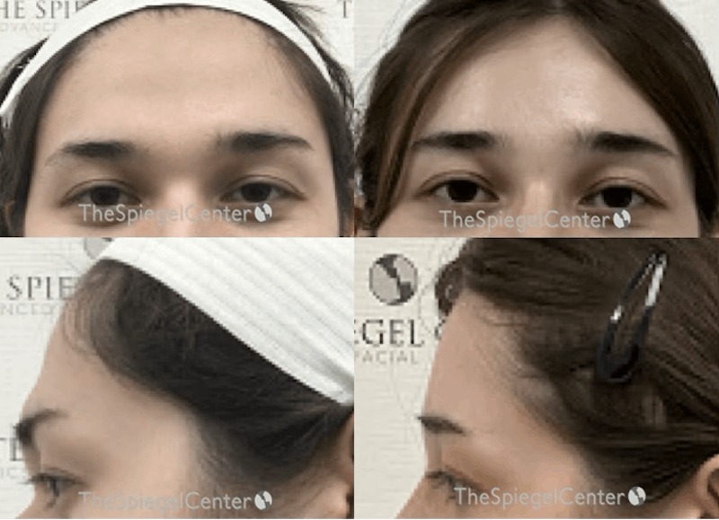 Forehead Contouring Before & After Gallery - Patient 314103 - Image 1