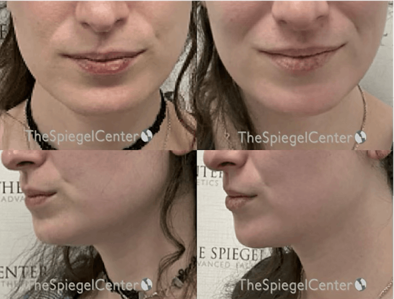 Masseter Botox Before & After Gallery - Patient 877302 - Image 1