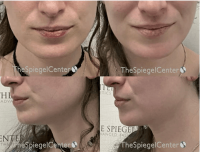 Masseter Botox Before & After Gallery - Patient 877302 - Image 1