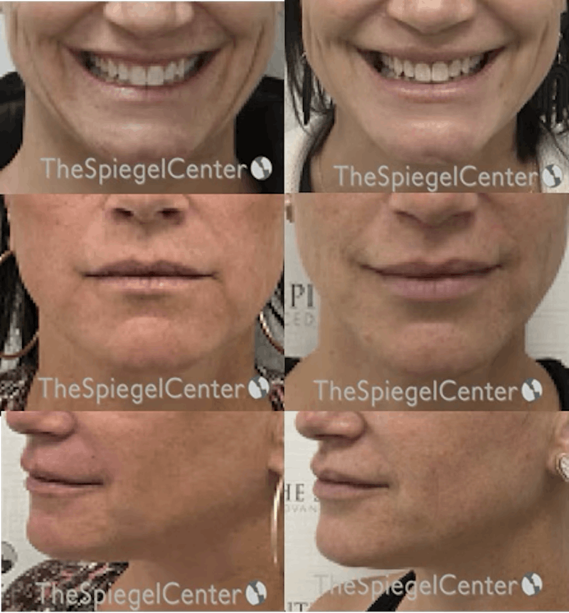 Lip Filler Before & After Gallery - Patient 168155 - Image 1