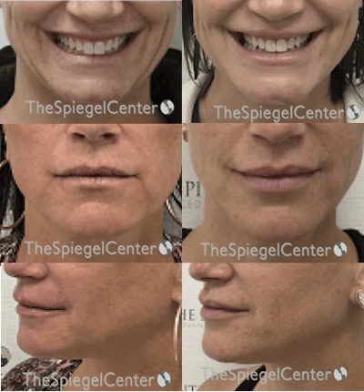 Lip Filler Before & After Gallery - Patient 168155 - Image 1