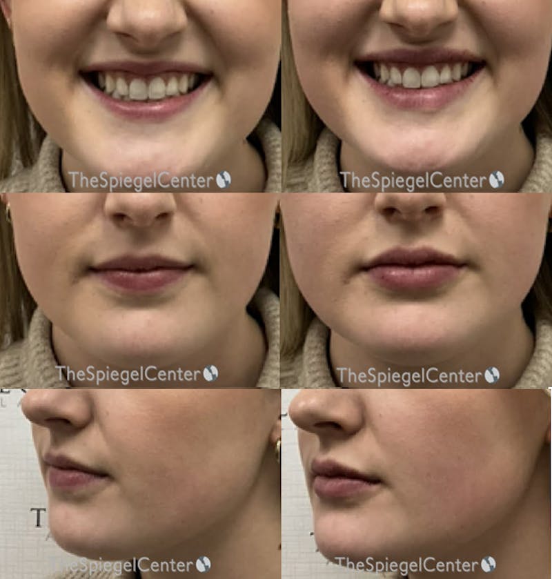 Lip Filler Before & After Gallery - Patient 375019 - Image 1