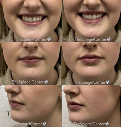 Lip Filler Before & After Gallery - Patient 375019 - Image 1