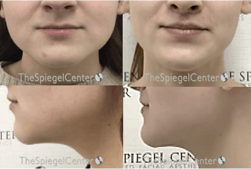 Mandible Contouring Before & After Gallery - Patient 398329 - Image 1